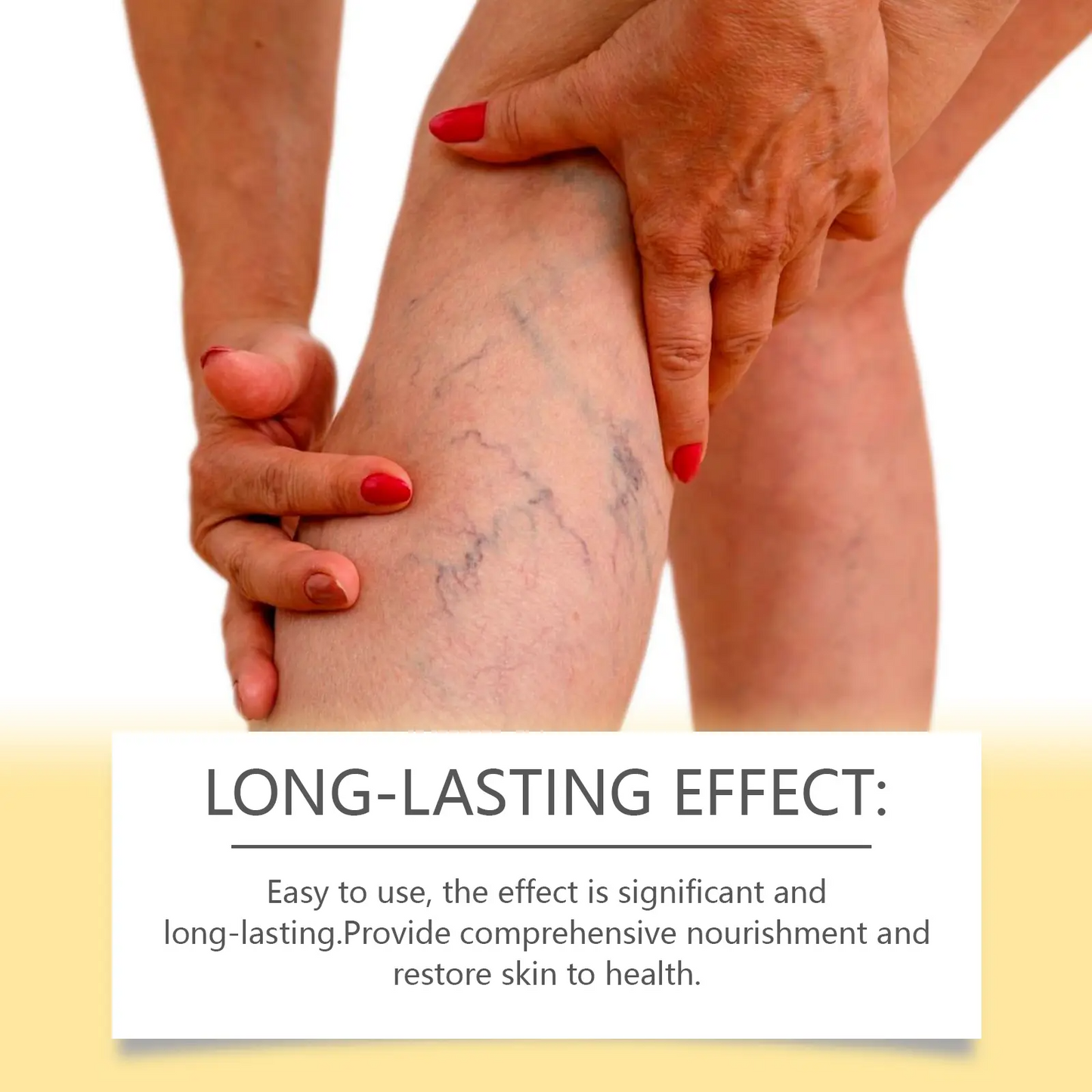 Bee Venom Extract Varicose Veins Cream, Pain & Swelling Relief Body Lotion, 100g Moisturizer