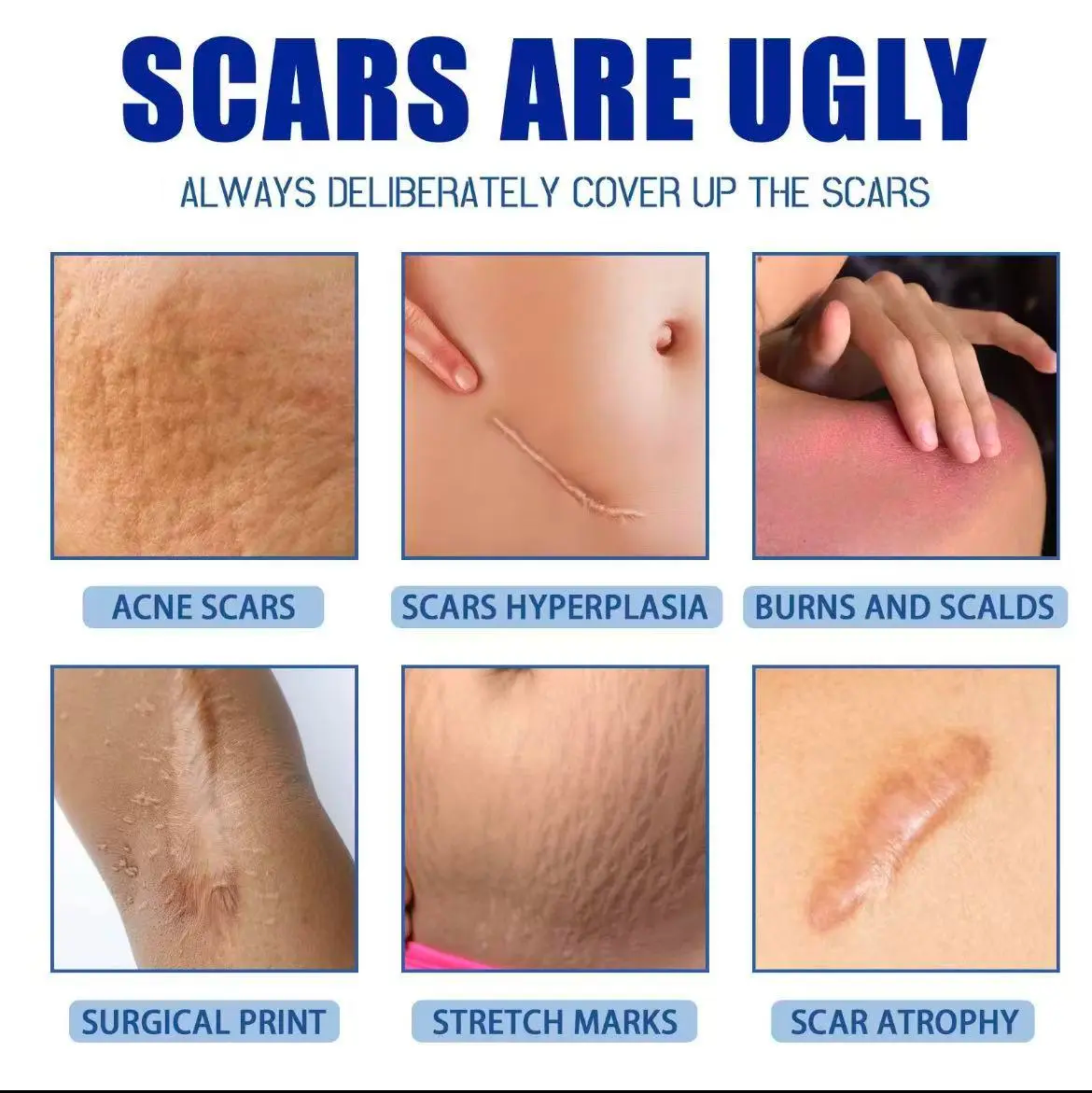 Professional Scar Removal Cream, AdvancedSilicone Skin Repair Gel for Burn,Acne Old Scar Removal Cream for Face & Body | Fades DarkScars