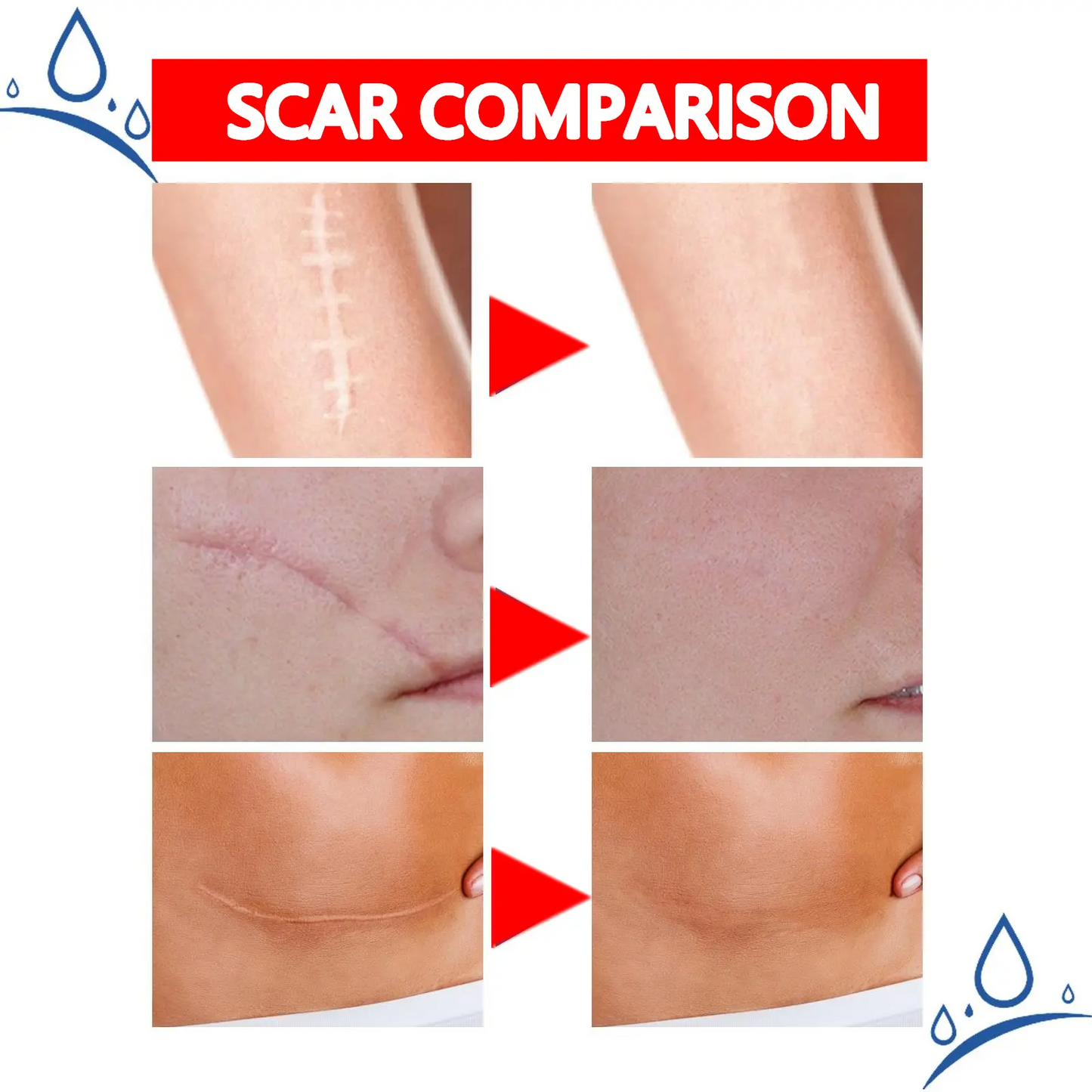 Professional Scar Removal Gel