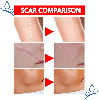 Professional Scar Removal Gel